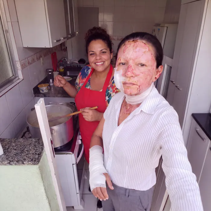 Ivone, com queimaduras no rosto e a mão direita enfaixada, na cozinha ao lado de uma mulher de avental vermelho que mexe uma panela grande